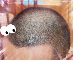 -大麦微针植发全国连锁