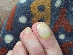 -祖传修脚甲沟炎灰指甲鸡眼