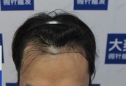 点击看大图 体验前-大麦微针植发丨全国连锁