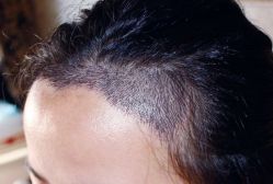 -大麦微针植发全国连锁