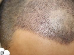 -大麦微针植发丨全国连锁