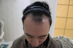 -大麦微针植发丨全国连锁