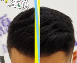 -大麦微针植发全国连锁