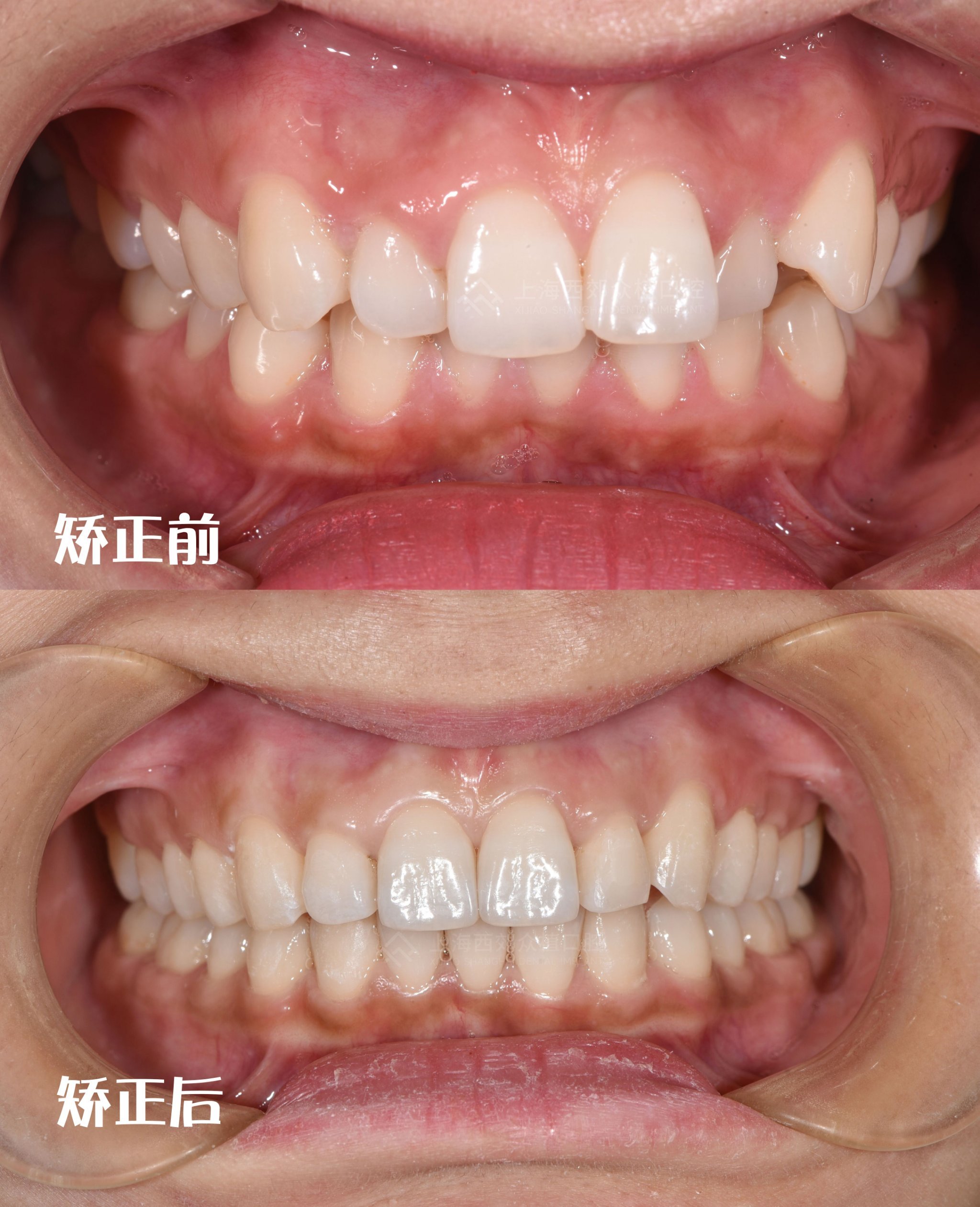 牙齿矫正|前后对比图来啦!