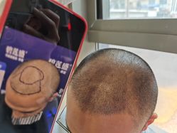 -碧莲盛·不剃发植发