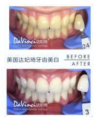 牙齿美白-光SPA科技美肤