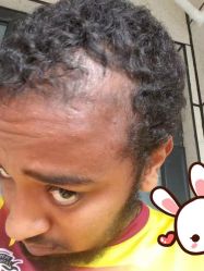 点击看大图 -大麦微针植发丨全国连锁