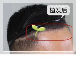 -大麦微针植发全国连锁