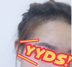 -大麦微针植发丨全国连锁