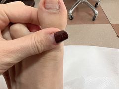 -世龙世家灰指甲鸡眼脚气甲沟炎跖疣护理(通州店)