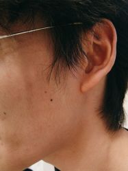 -塑青春&伊肤泉祛痘皮肤管理