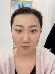 体验后-More摩尔医美の注射线雕光电中心