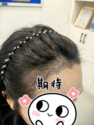 -大麦微针植发全国连锁