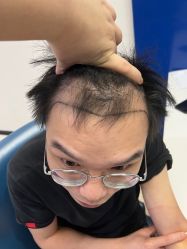 体验前-大麦微针植发全国连锁