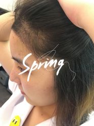 -大麦微针植发全国连锁