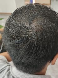 -碧莲盛·不剃发植发