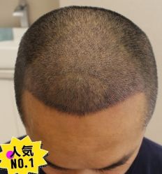 -大麦微针植发丨全国连锁