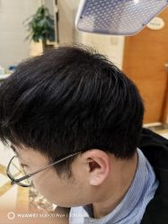 -碧莲盛·不剃发植发