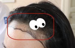 -大麦微针植发全国连锁