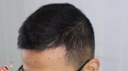 -大麦微针植发丨全国连锁