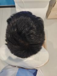 -大麦微针植发全国连锁
