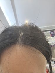 -大麦微针植发丨全国连锁