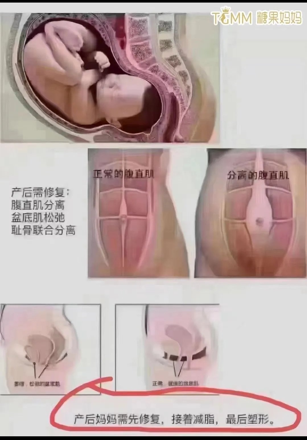 产后宫腔分离图片