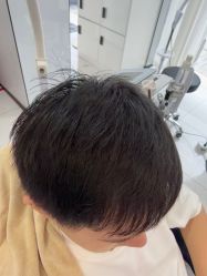 -大麦微针植发丨全国连锁