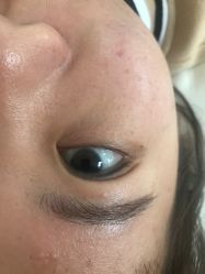 -美丽人生祛斑扁平疣汗管瘤中心