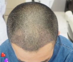 -大麦微针植发丨全国连锁