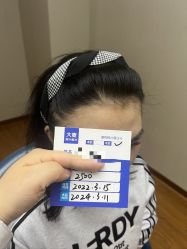 体验后-大麦微针植发全国连锁