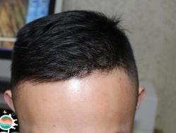 -大麦微针植发丨全国连锁