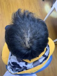 -大麦微针植发全国连锁