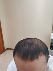 -碧莲盛·不剃发植发