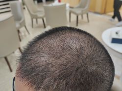 -大麦微针植发全国连锁