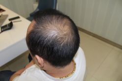 -大麦微针植发丨全国连锁