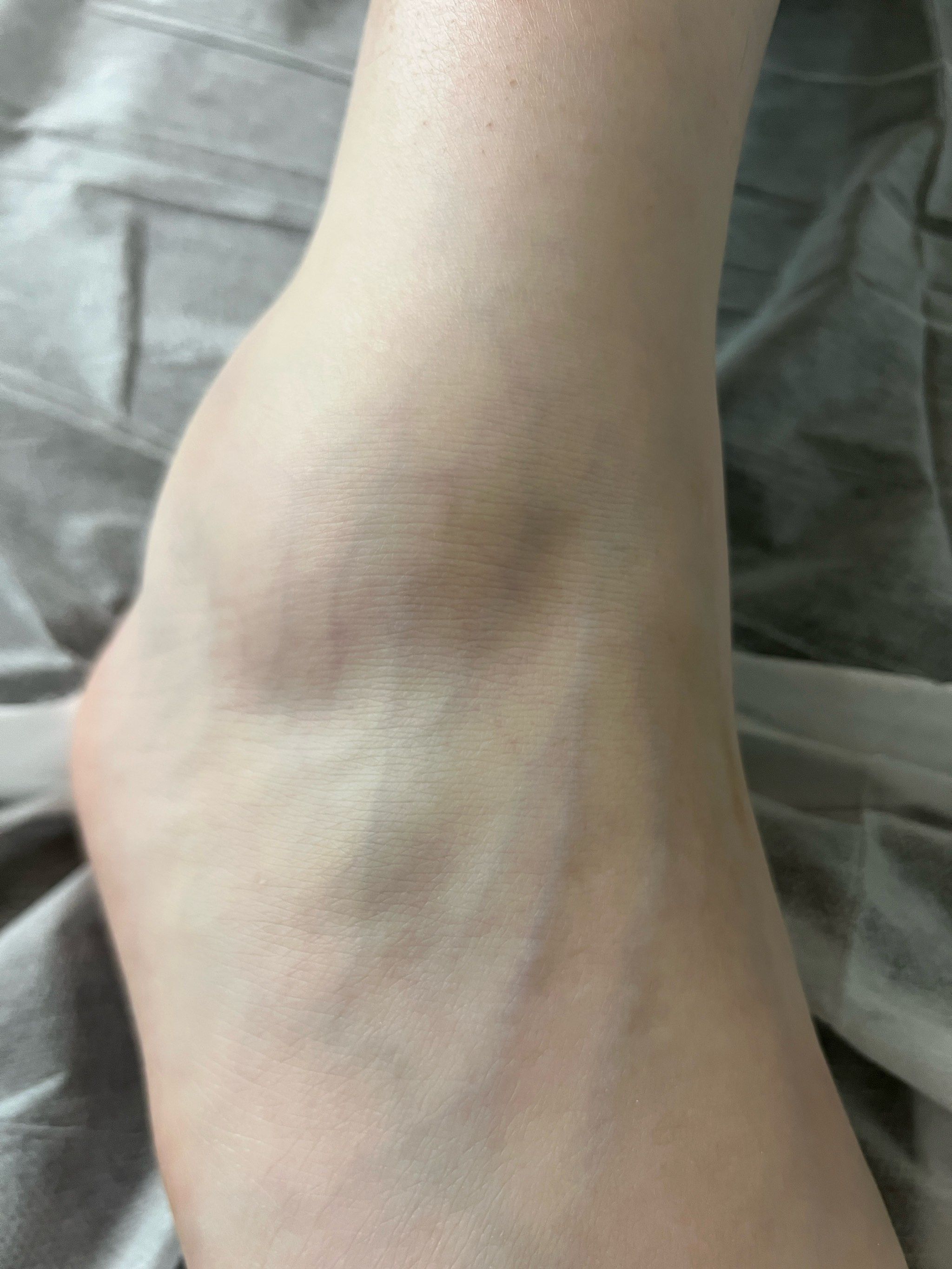 急性踝扭伤消肿