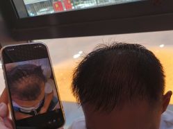 -碧莲盛·不剃发植发