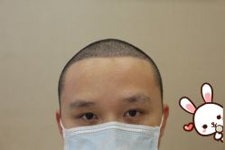 -大麦微针植发丨全国连锁