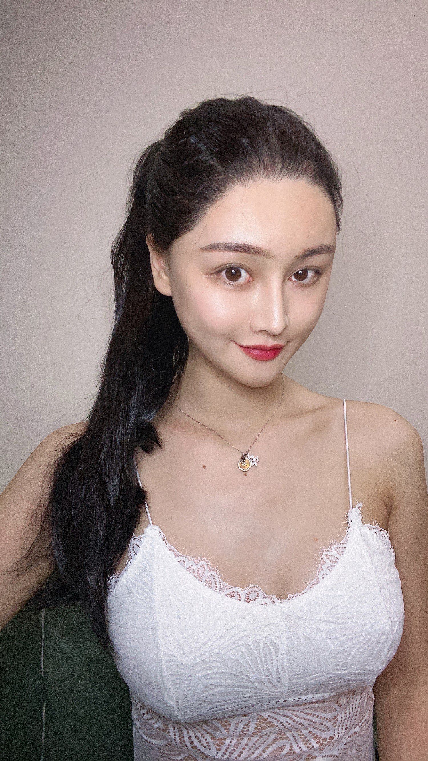 假体隆胸体验后62天效果分享