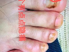 -世龙世家灰指甲·甲沟炎·跖疣护理·修脚(东江湾路店)