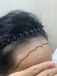 体验前-熙朵美学植发·连锁品牌