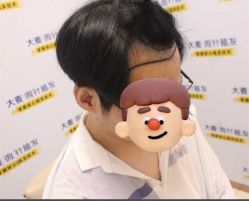 -大麦微针植发丨全国连锁