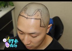 -大麦微针植发全国连锁