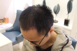 -大麦微针植发丨全国连锁