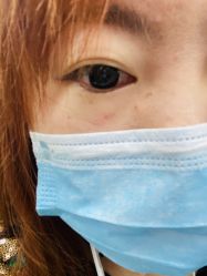 -爱莎扁平疣·汗管瘤·斑痣中心