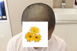 -大麦微针植发丨全国连锁