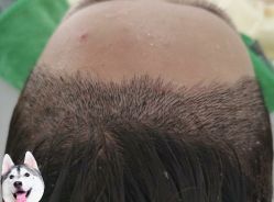 -大麦微针植发丨全国连锁