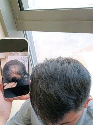 -碧莲盛·不剃发植发