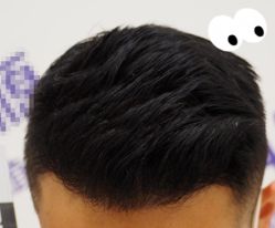 -大麦微针植发全国连锁